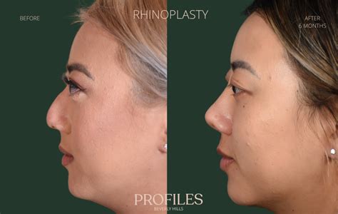 nose piercing after rhinoplasty